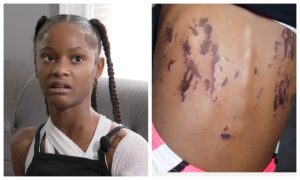 12-Year-Old Criminally Charged in Awful Playground Acid Attack